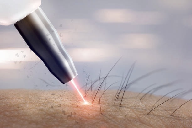 Similar and Related Procedures to Brazilian Laser Hair Removal
