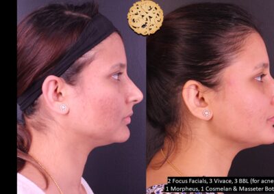 Side profile comparison of skin rejuvenation treatments on a female patient.
