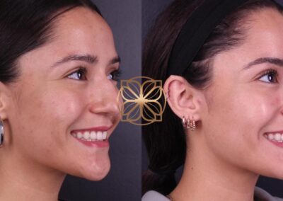 Smiling profile comparison before and after comprehensive Botox to chin, gummy smile correction, and fillers to nose, tear troughs, lips, and marionettes