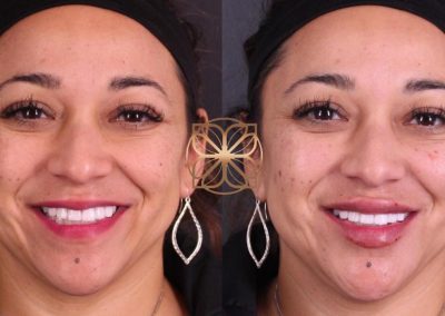 Spa26 B&A filler.pptx (1)