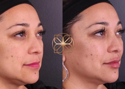 Spa26 B&A filler.pptx (2)