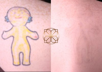 Tattoo Removal After 7 Sessions Spa26 Beverly Hills