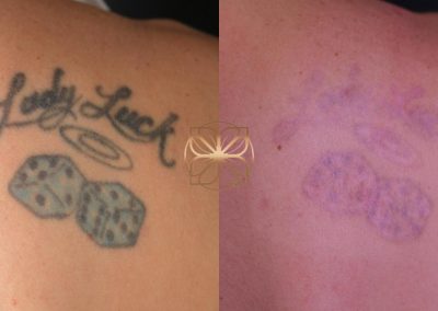 Tattoo Removal After 7 Treatments Spa26 Beverly Hills