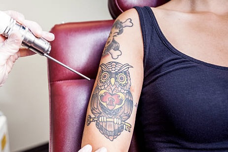 tattoo removal benefits