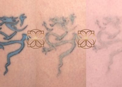 Tattoo Removal Progression 2 Treatments Spa26 Beverly Hills