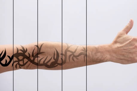 tattoo removal side effects and risks