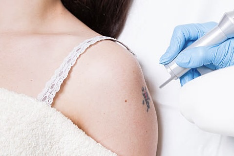 tattoo removal treatment areas