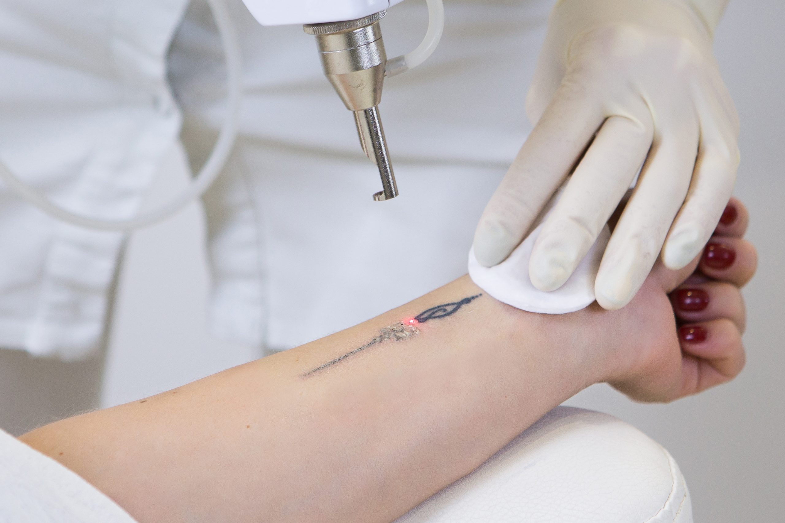 Close-up,Of,Laser,Tattoo,Removal,From,Woman,Hand. tattoo removal treatment