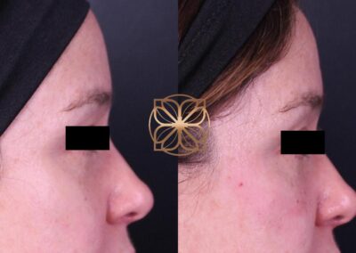 Before and after side profile of tear through filler treatment, displaying reduced eye lines and under-eye smoothness