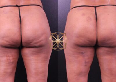 Visible cellulite reduction on thighs after Cellfina treatment, showcasing smoother skin texture and less dimpling