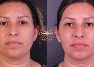 Frontal before and after results of FaceTite treatment at 3 months, demonstrating significant facial skin improvement