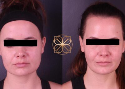 Profile comparison 3 months post-FaceTite and BFPR treatment, showing visible skin tightening and contouring in a Beverly Hills clinic