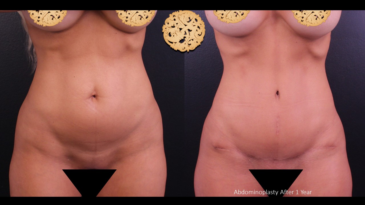Halo Fractional Laser Resurfacing before and after
