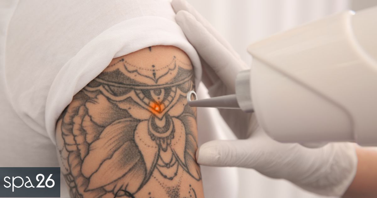 Types of Tattoo Removal Treatments