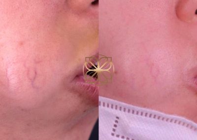 Vein Removal After 1 Treatment Spa26 Beverly Hills.pptx