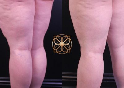 Vein Removal on Legs Spa26 Beverly Hills.pptx