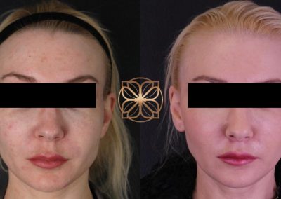Vivace and Microlaser Peel After 7 Months Spa26 Beverly Hills