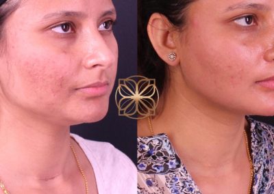 Vivace, Morpheus, BBL Dermal Infusion 4 Months Post Post Op Spa26 Beverly Hills