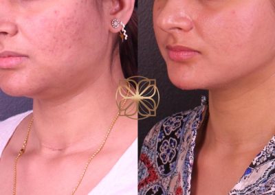 Vivace, Morpheus, BBL Dermal Infusion 4 Months Post Post Op Spa26 Beverly Hills