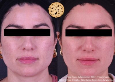 Woman's face before and after treatments including fillers and microneedling, with improvements in tear troughs, nasolabial folds, lips, and marionette lines.