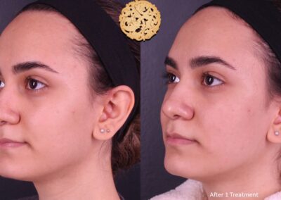Profile view of a young woman before and after one microneedling treatment showing skin improvements with SPA26.