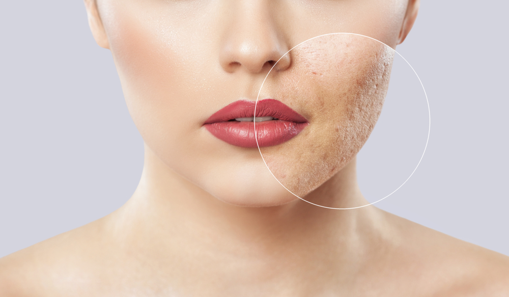 Close-up of a woman's face showing skin affected by the causes of acne rosacea