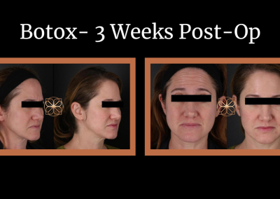 botox 3 weeks post-op before and after
