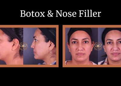 Botox and nose filler before and after
