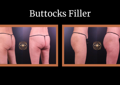 Buttocks Filler before and after