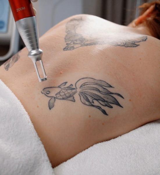 Tattoo Removal Beverly Hills