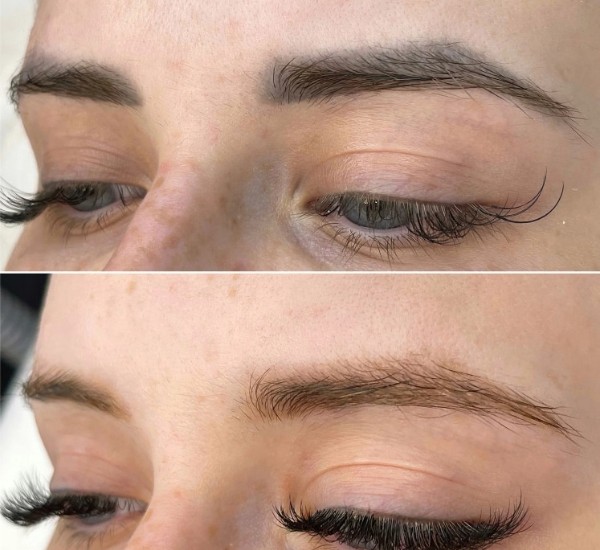 Eyebrow Tattoo Removal with Nanosecond Lasers