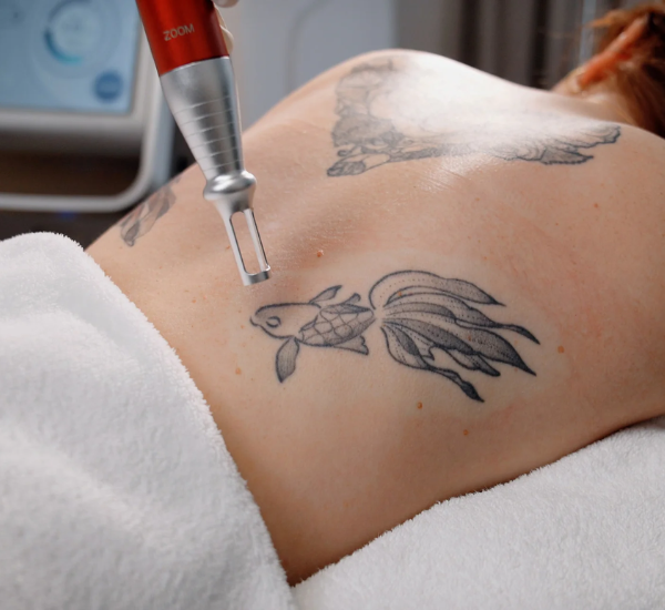 Picosecond laser treatments in LA