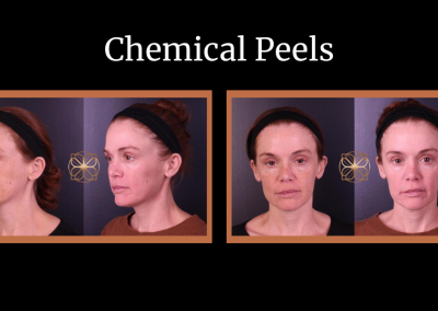 Chemical peels before and after