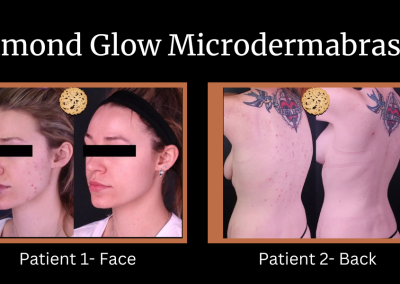 Diamond Glow Microdermabrasion before and after