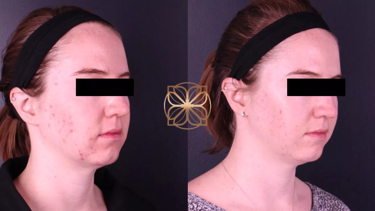 Liquid Facelift before and after