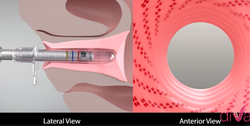 diVa How the Procedure Works 1