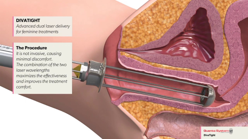 diVa How the Procedure Works 2