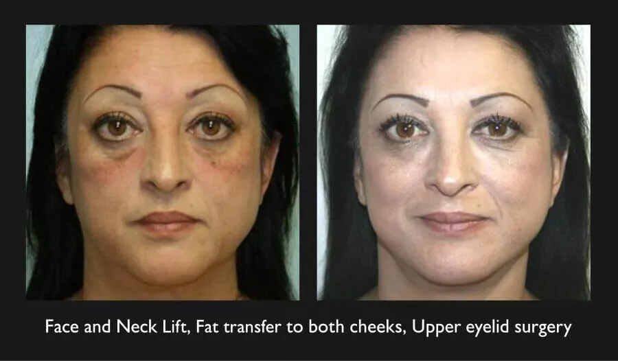 Face and Neck lift before and after