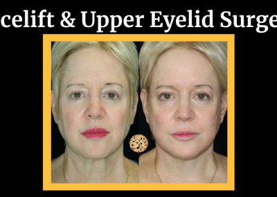 Facelift and Upper Eyelid Surgery