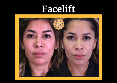 Facelift before and after