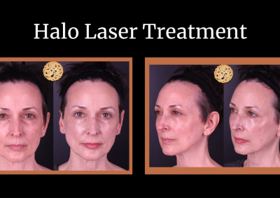 Halo laser treatment before and after