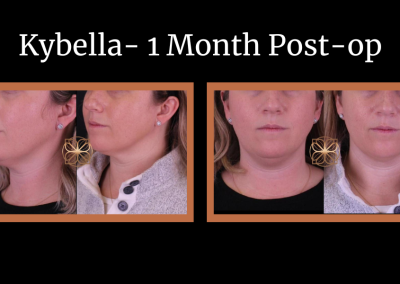 Kybella 1 Month post-op before and after