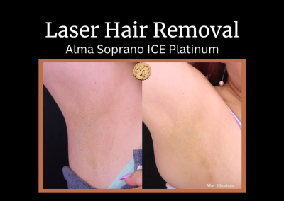 Laser hair removal before and after