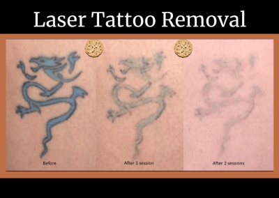 Laser tattoo removal before and after