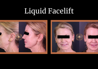 Liquid facelift before and after