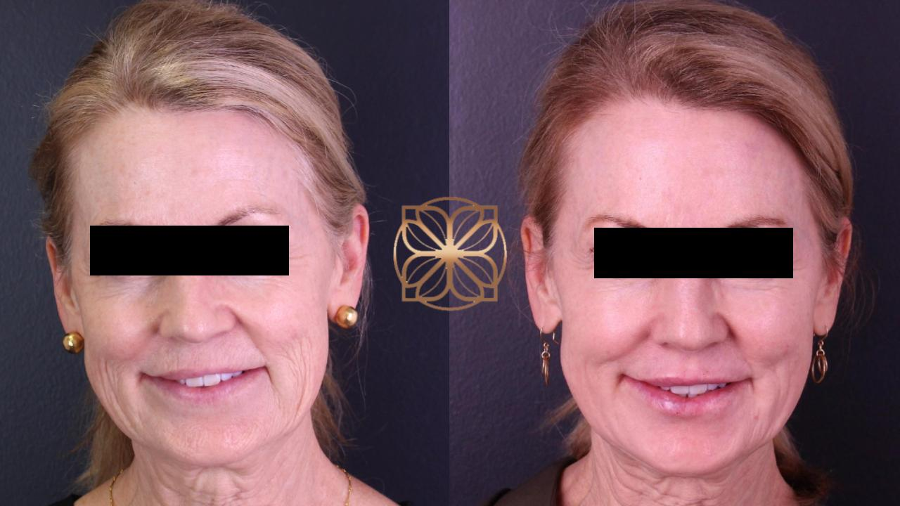 Liquid Facelift before and after