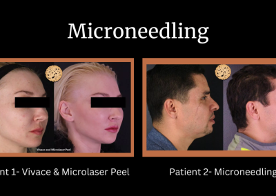 Microneedling before and after