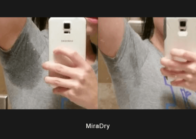 Comparison of underarms before and after miraDry treatment demonstrating sweat reduction and dryness.
