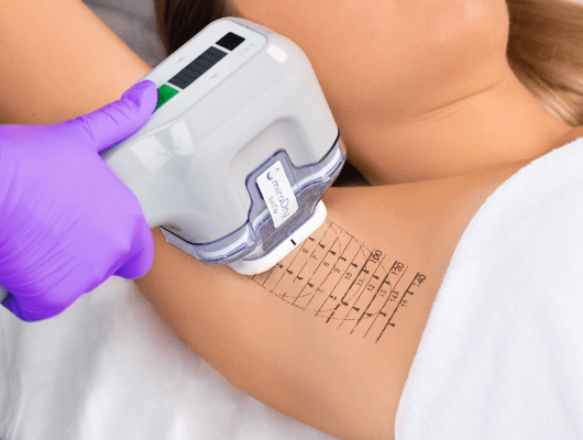 miraDry Sweat Reduction Beverly Hills