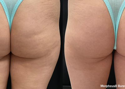 Before and after results of Morpheus8 Burst Deep treatment for skin tightening on buttocks